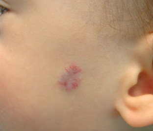 hemangioma infantil e malformações