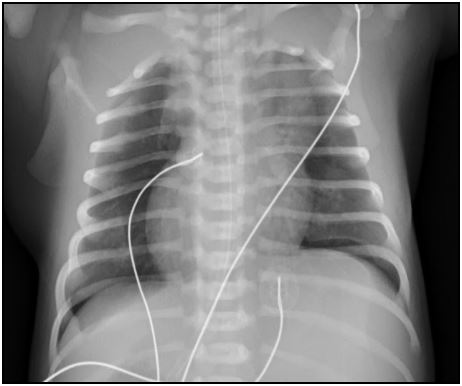 Radiografia de tórax no recém-nascido | Pedipedia - Enciclopédia